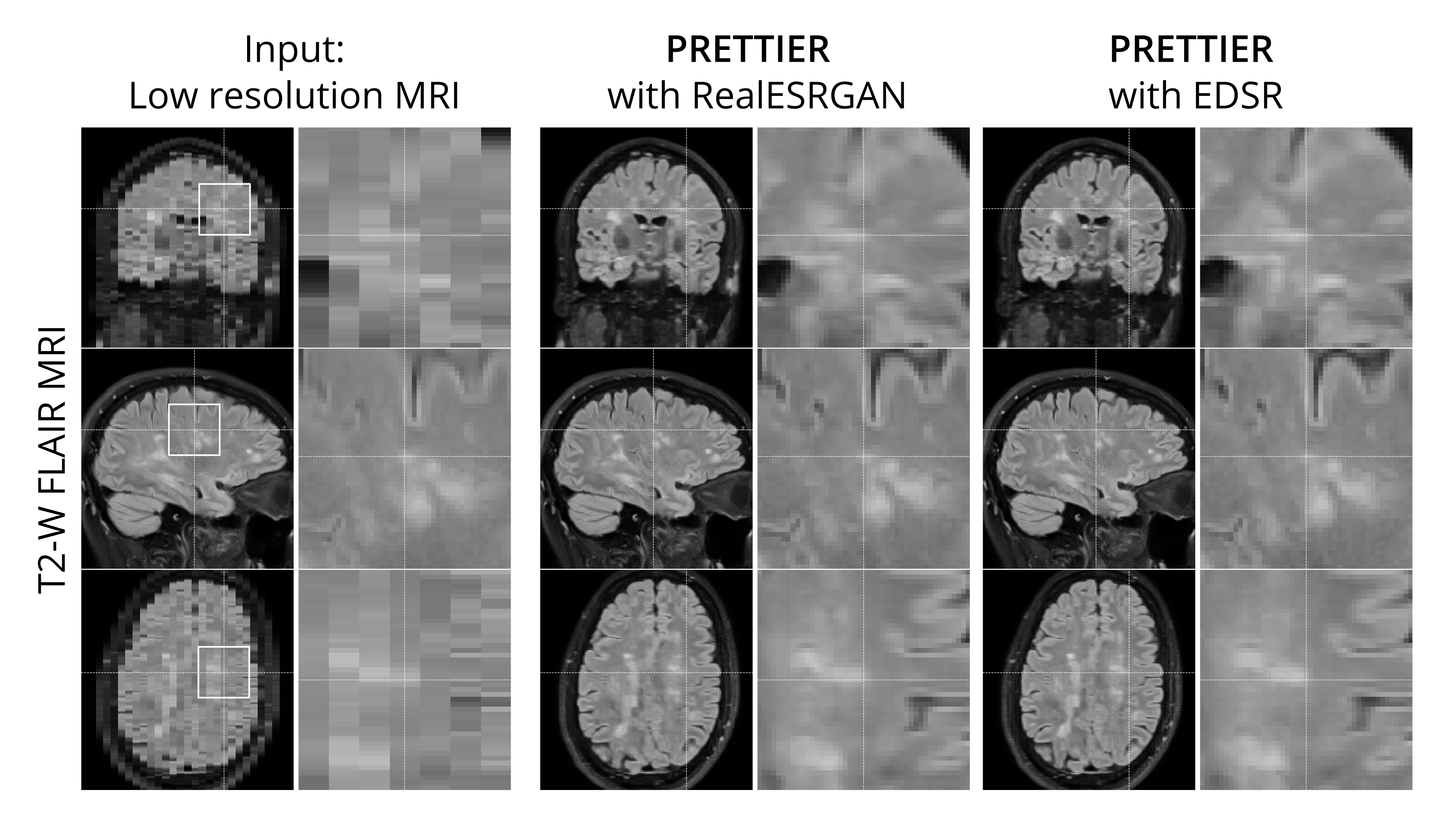 Example of PRETTIER MRI